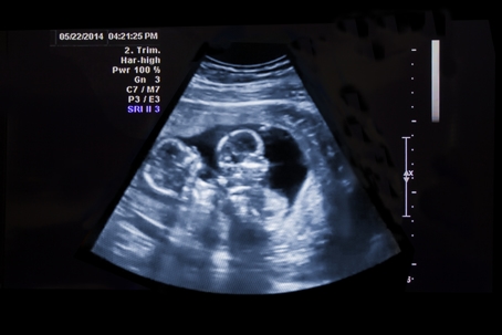 Twins Ultrasound
